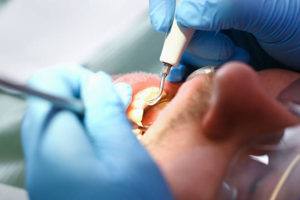Best Emergency Root Canal Treatment in Edgemoor, DE
