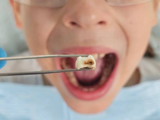 Best Emergency Tooth Extraction in Edgemoor, DE